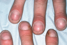 Nail–patella syndrome: report of 11 pediatric cases - Figueroa‐Silva - 2016  - Journal of the European Academy of Dermatology and Venereology - Wiley  Online Library