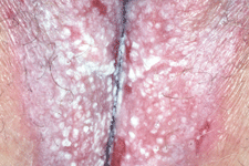 Rash on vag lips treatment deals