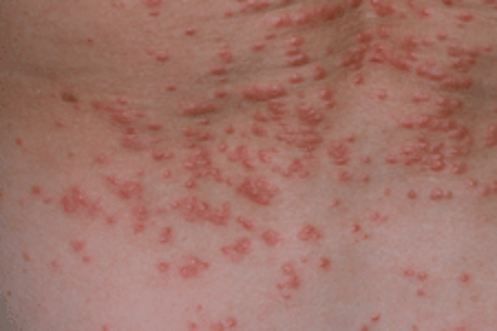 Scabies skin rash