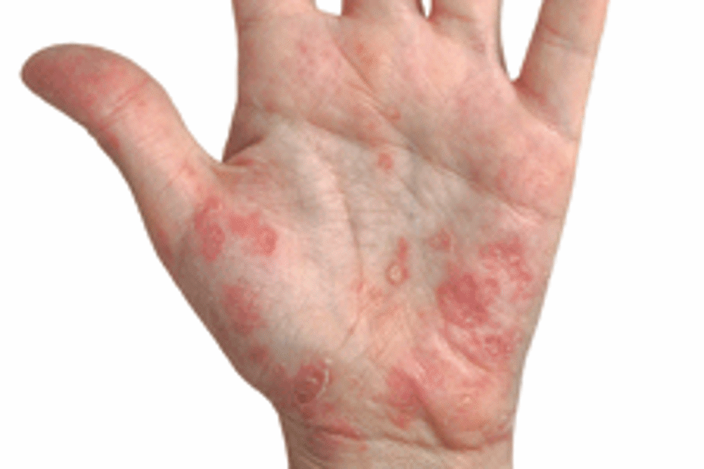 Itchy dermatitis of the hand