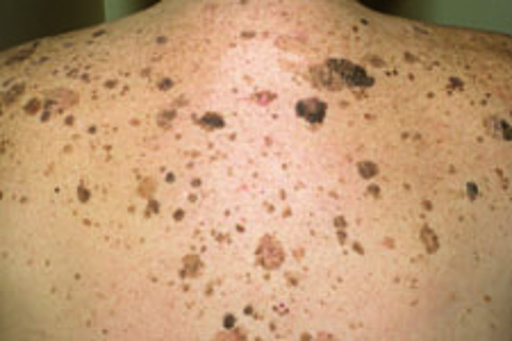 What is the Most Common Skin Problem in the Elderly?  